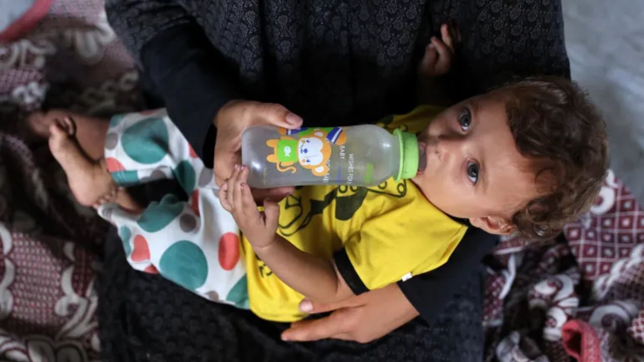 গাজায় ৫ বছরের নিচের শিশুরা প্রাণঘাতী অপুষ্টির ঝুঁকিতে